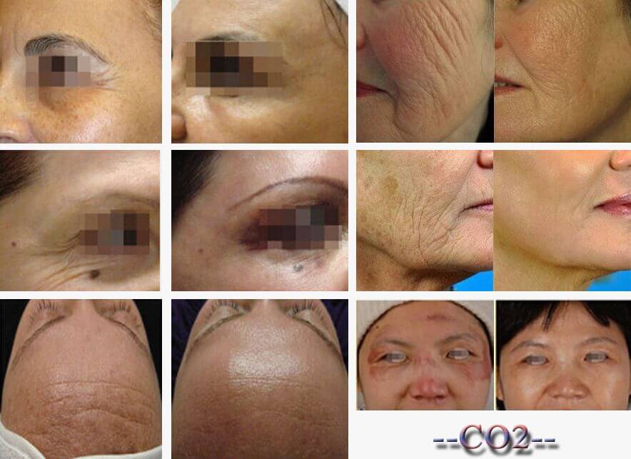 Fractional CO2 laser scar removal - Zhengzhou, Henan, China