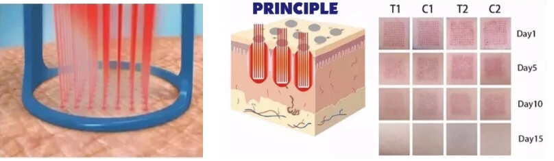 the principle of fractional laser machine