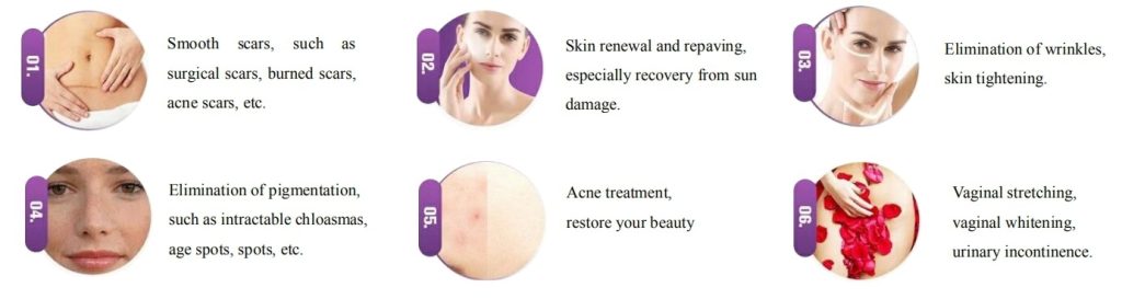 CO2 laser before and after acne scars