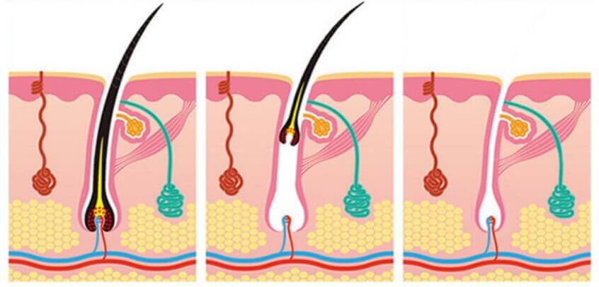 permanent laser hair removal machine