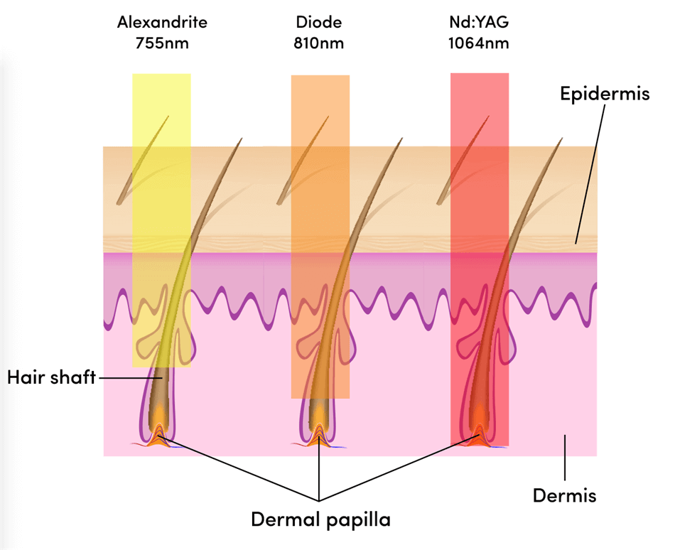 laser hair removal machine