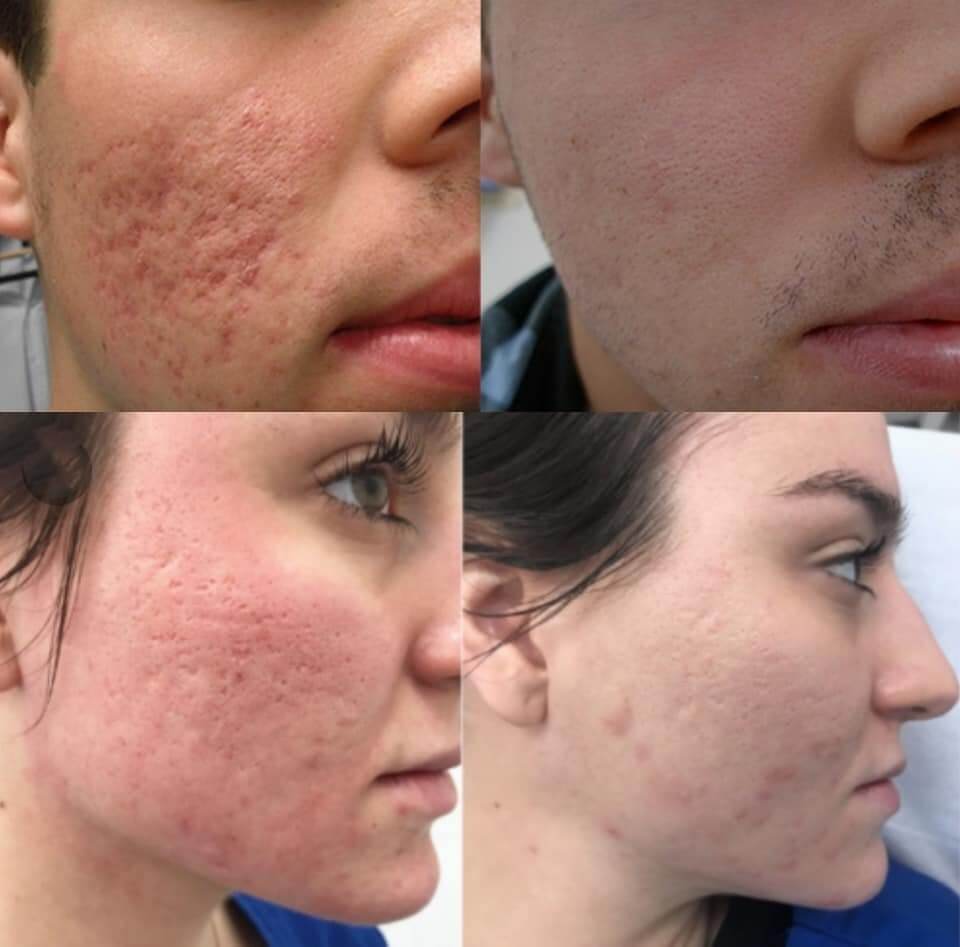 CO2 laser before and after acne scars.