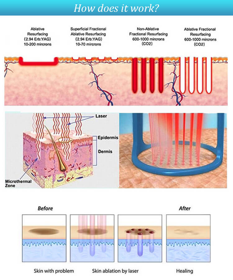 Fractional CO2 laser scar removal - Zhengzhou, Henan, China