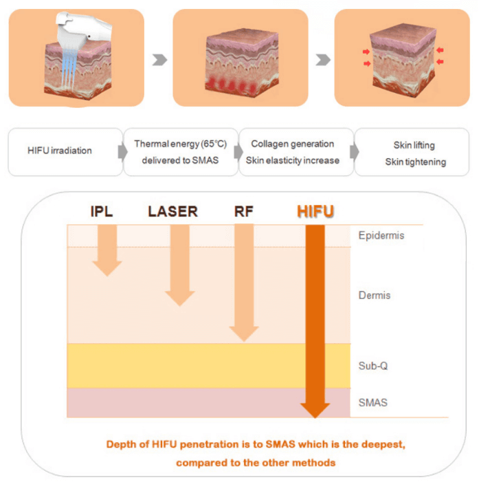 4D HIFU machine