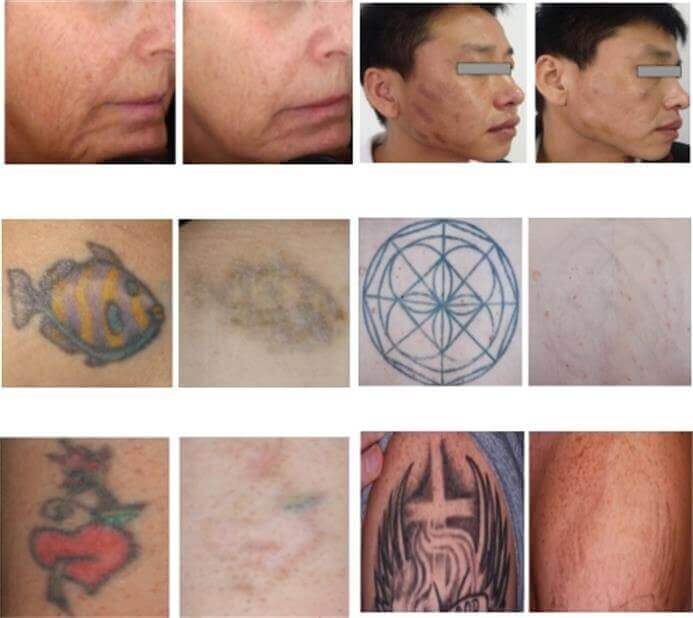 laser tattoo removal machine