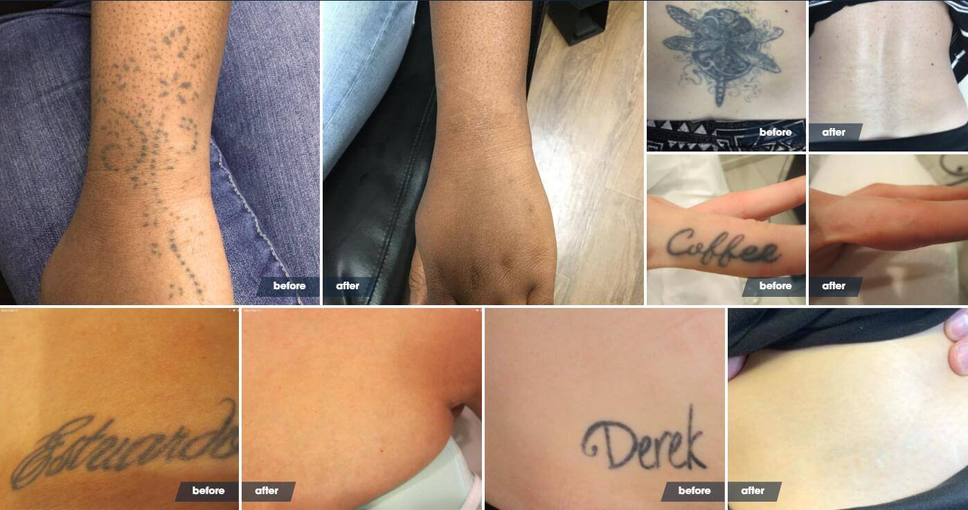 tattoo removal machine before and after