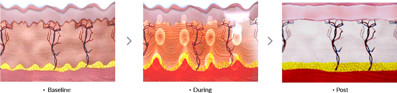 hifu treatment process