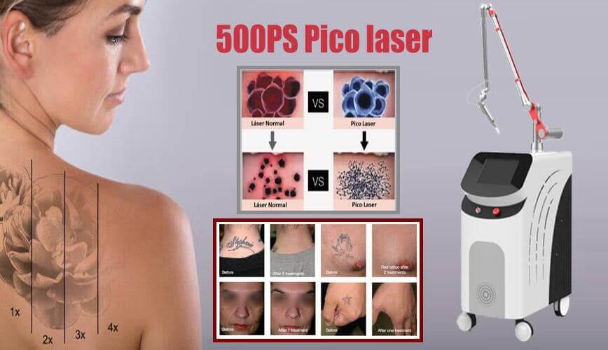 professional laser tattoo removal machine for sale