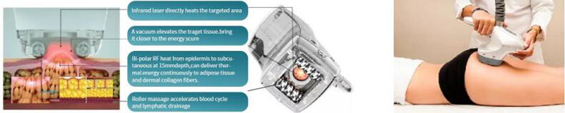 velashape treatment