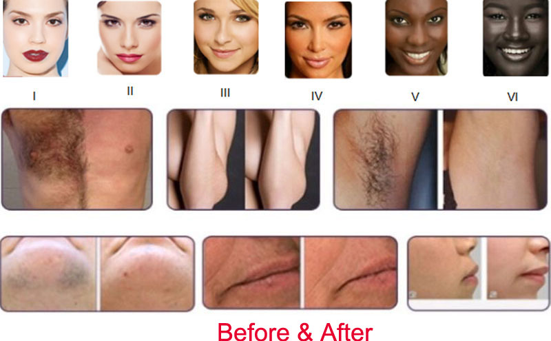 permanent laser hair removal