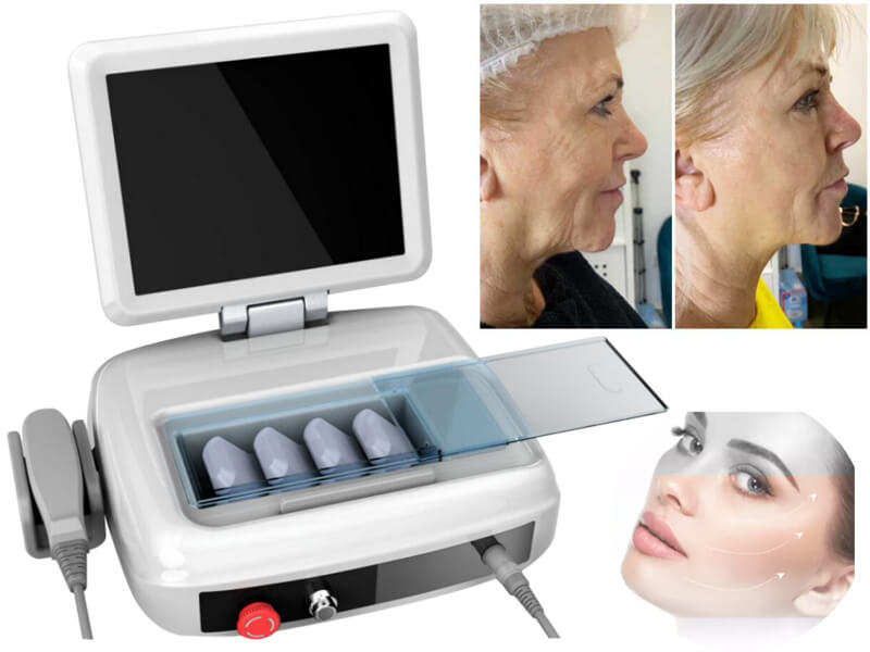 hifu skin rejuvenation machine