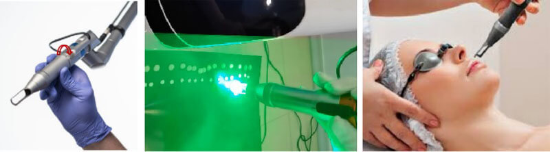 picosure laser machine
