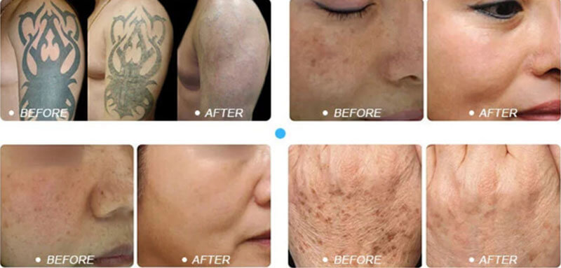 picosecond laser treatment before and after