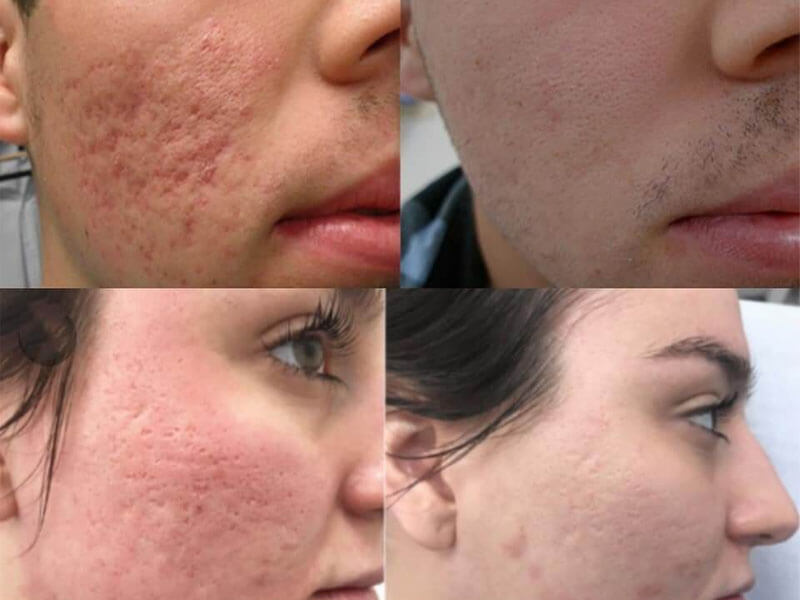 co2 fractional laser skin resurfacing treatment