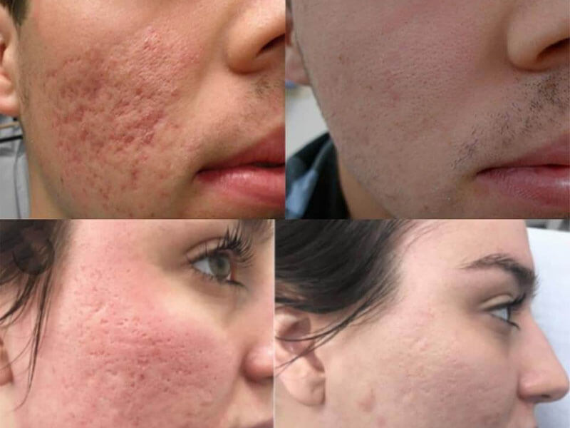 co2 laser treatment before and after