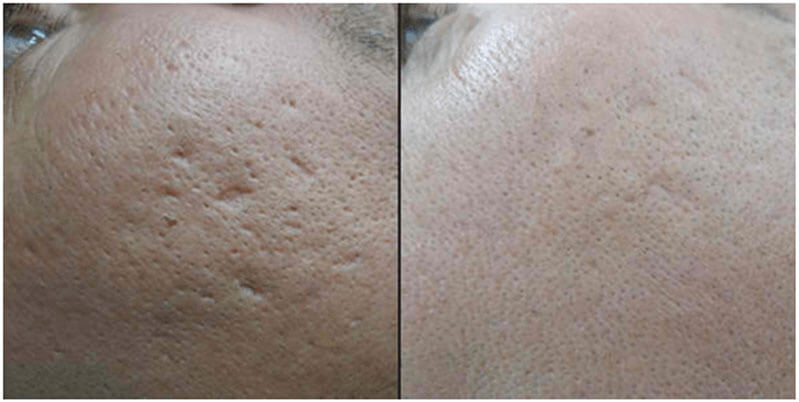 co2 fractional laser before and after