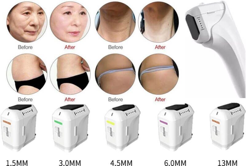 hifu skin rejuvenation machine