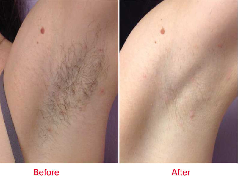 laser hair removal before and after