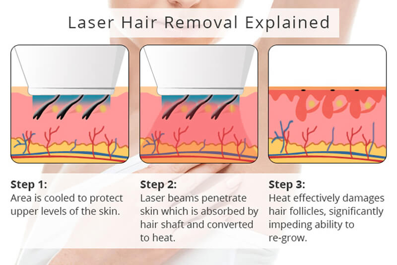 laser hair removal treatment