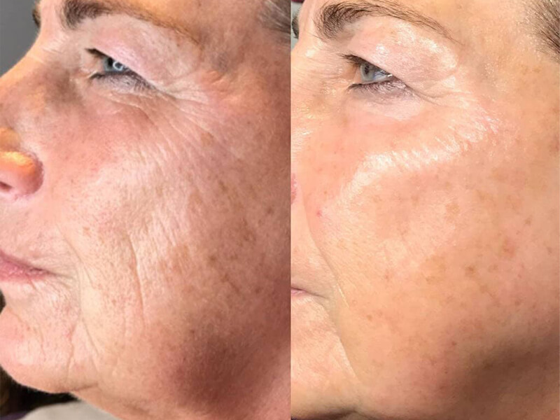 picosure freckle removal