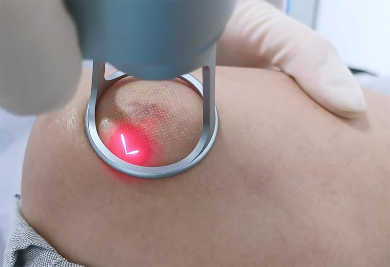 co2 fractional laser treatment