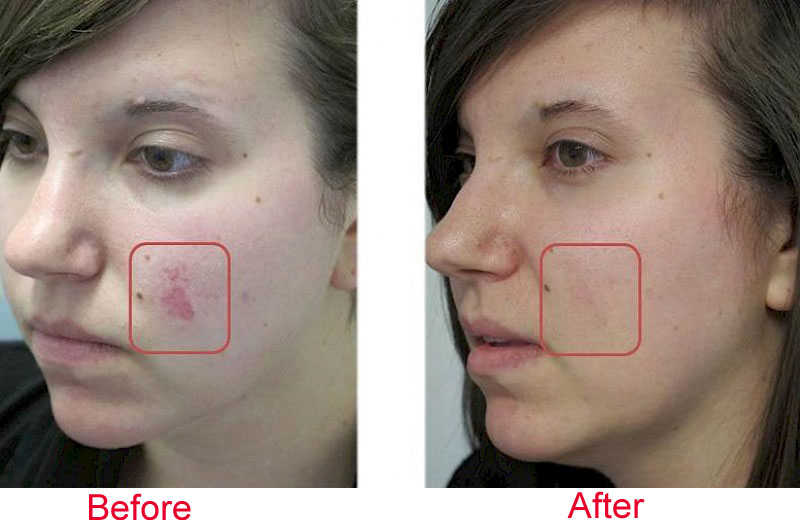 co2 fractional laser machine treatment before and after