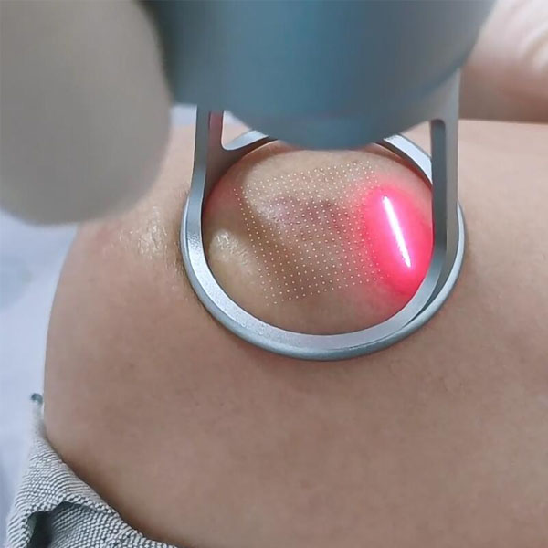 What is CO2 Fractional Laser Treatment