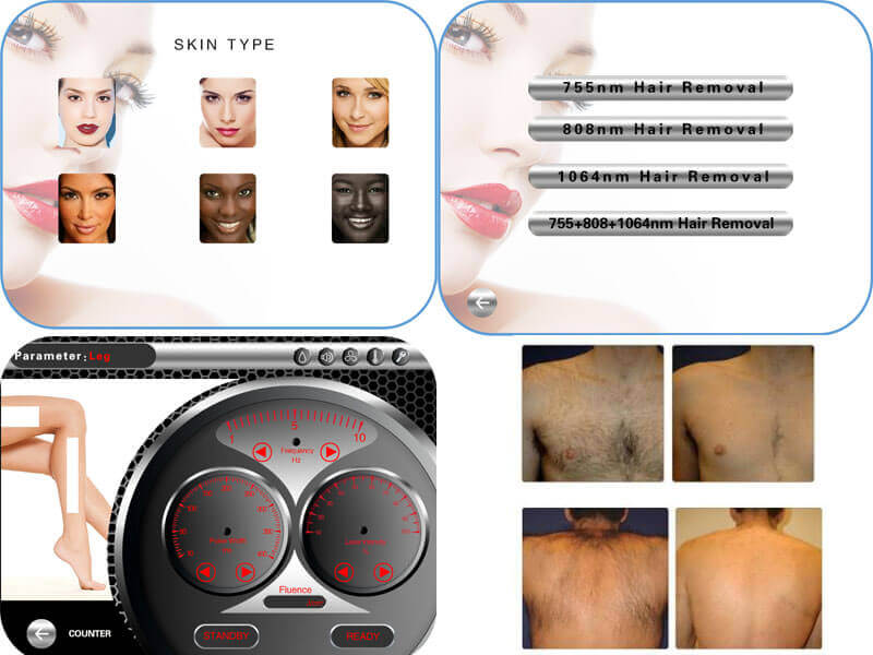 trilaser diode hair removal machine