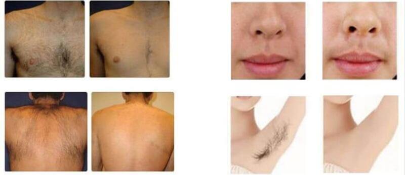 best permanent hair removal laser machine