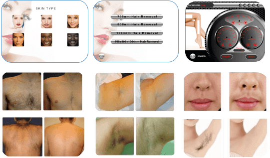 The new scientific diode laser hair removal beauty machine treatment method