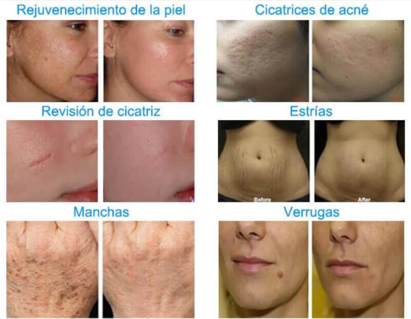 co2 fractional laser scar removal equipment