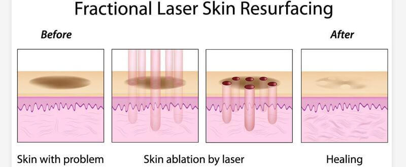 co2 fractional laser non ablative