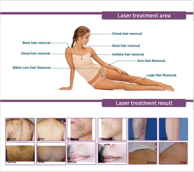 body laser hair removal machine