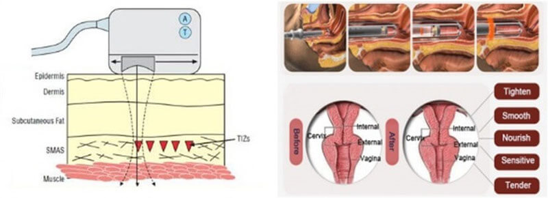 hifu beauty machine treatment