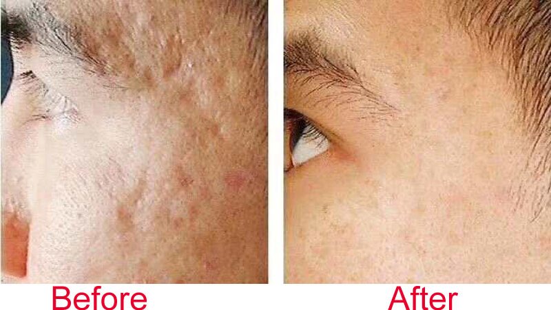 co2 fractional laser acne scar removal