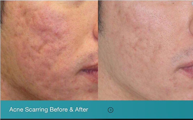 co2 fractional laser acne scar removal