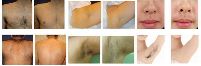 laser hair removal treatment