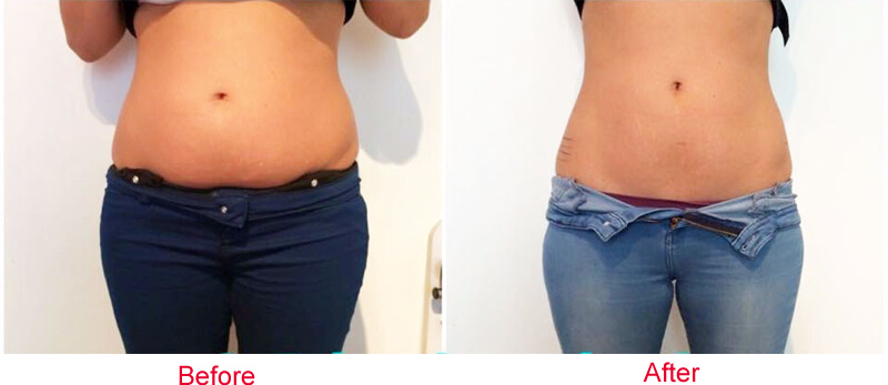 cryolipolysis treatment before and after