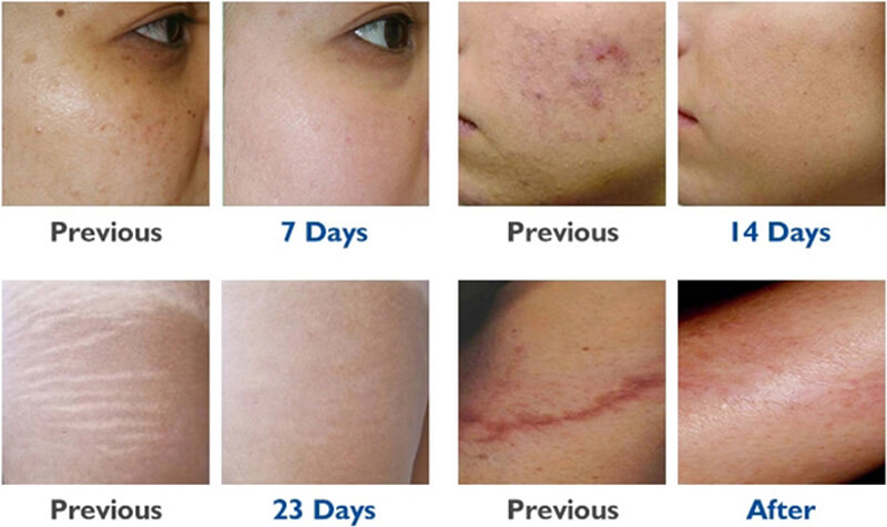 co2 laser treatment before and after