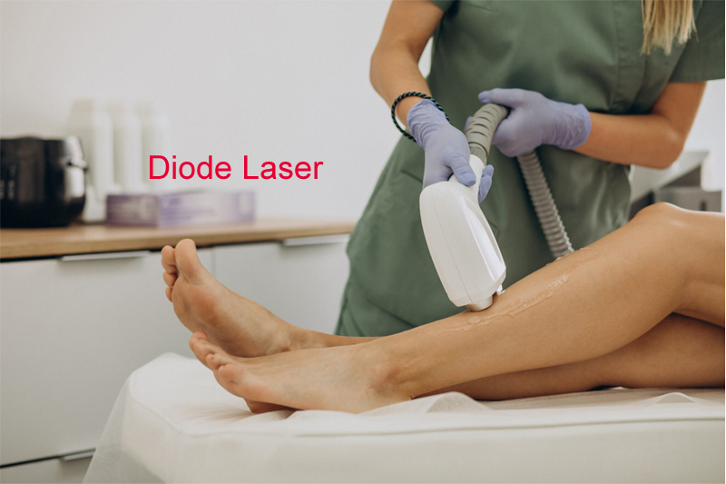 laser hair removal treatment