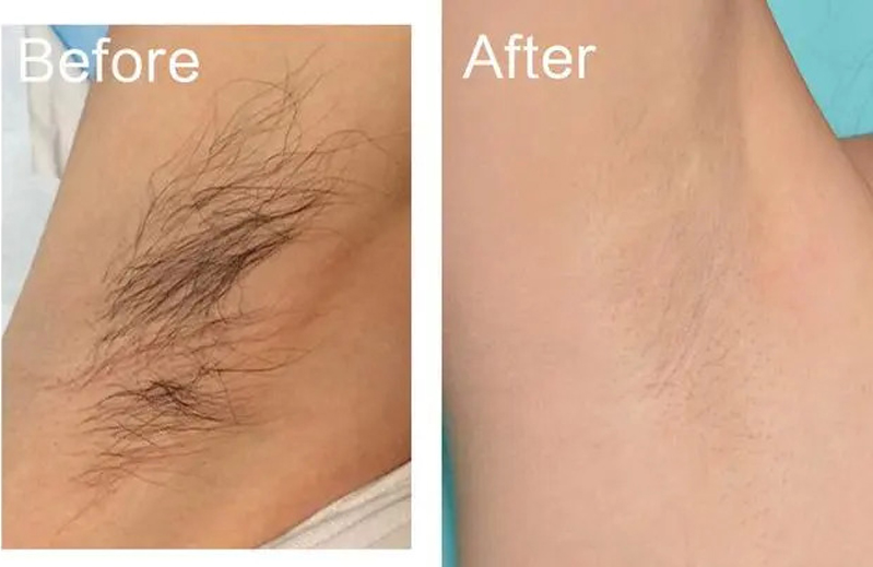 laser hair removal treatment before and after