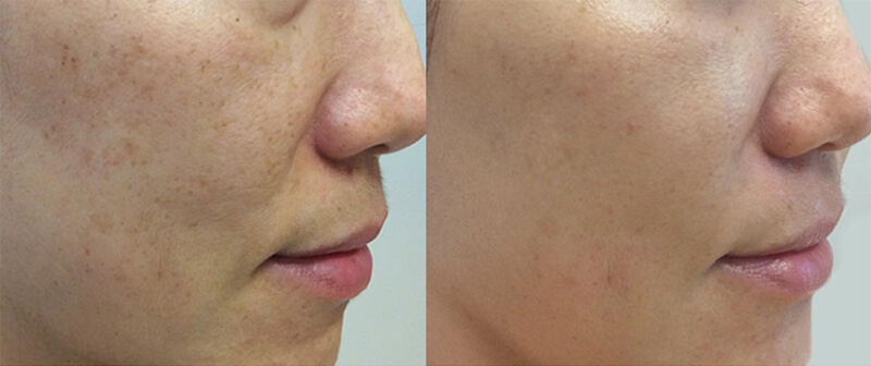 picosecond laser treatment