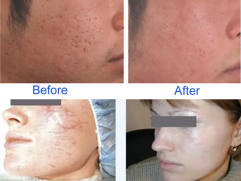 co2 fractional laser treatment before and after