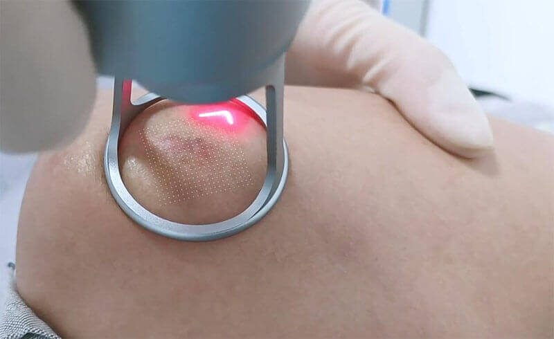 co2 fractional laser machine treatment