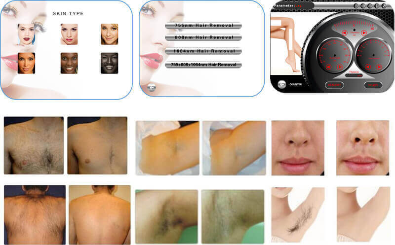 diode laser hair removal machine