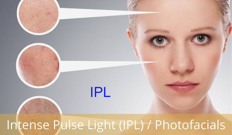 ipl beauty machine