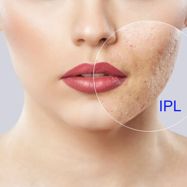 The best professional IPL machine for skin rejuvenation