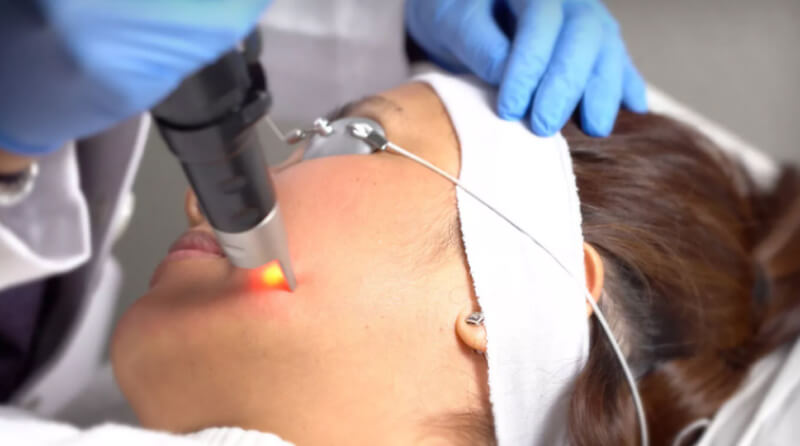 picosecond laser treatment