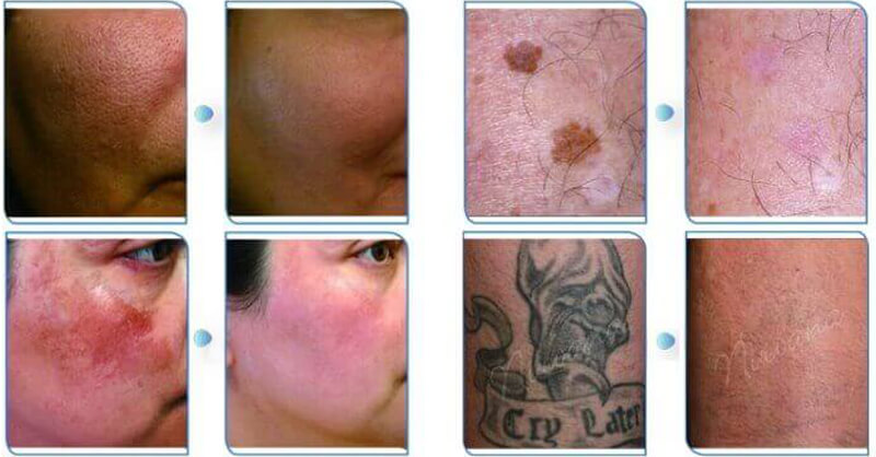 picosecond laser treatment