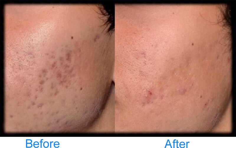 picosecond laser before and after